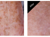 Hyperpigmentation Treatment Carmel IN