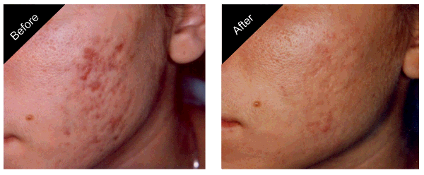 Mandag kæmpe tilpasningsevne Acne Treatment Carmel | Blue Light Therapy | The New You Esthetics