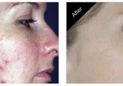 Acne Treatment Carmel IN