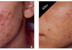 Acne Scar Treatment Carmel