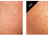 Carmel IN Hair Removal