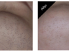 Hair Removal For Men Carmel