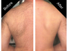Back Hair Removal Carmel IN