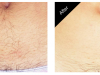 Laser Hair Removal Carmel
