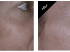 Pigmented Lesion Removal Carmel