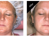 Freckle Removal Carmel Indiana