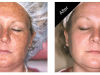 Freckle Removal Carmel Indiana