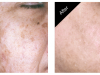 Hyperpigmentation Treatmemts Carmel