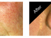 Rosacea Treatment Carmel