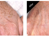 Anti Aging Skin Care in Carmel