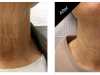 Carmel IN Anti Aging Treatments