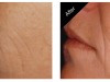 Skin Tightening Treatment Carmel Indiana