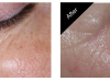 Wrinkle Treatment Carmel